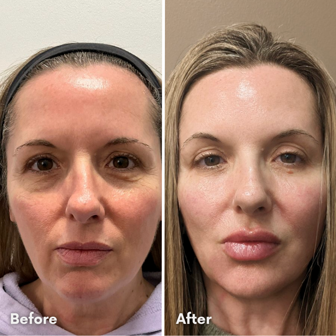 DermaVision™ Under-Eye Red Light Therapy